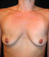 Patient # 85355 Before Photo # 1