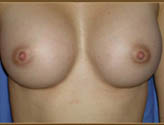 Patient # 97855 After Photo # 2