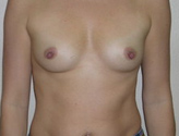 Patient # 67913 Before Photo # 1