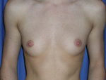 Patient # 29173 Before Photo # 1