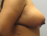 Patient # 81559 After Photo # 6