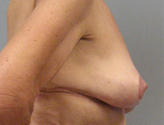 Patient # 23212 After Photo # 6
