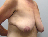 Patient # 23212 Before Photo # 3