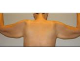 Patient # 24366 Before Photo # 1