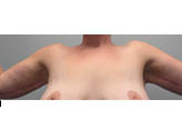 Patient # 43999 After Photo # 2