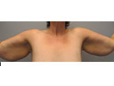 Patient # 43999 Before Photo # 1
