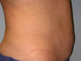 Patient # 58862 After Photo # 6