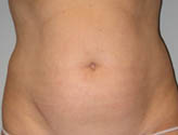 Patient # 58862 Before Photo # 1