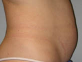 Patient # 58862 Before Photo # 5