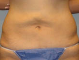 Patient # 42430 After Photo # 2