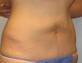 Patient # 42430 After Photo # 4