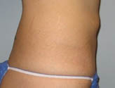 Patient # 42430 After Photo # 6