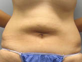 Patient # 42430 Before Photo # 1