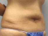 Patient # 42430 Before Photo # 3