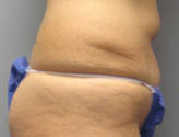 Patient # 42430 Before Photo # 5