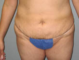 Patient # 27635 After Photo # 2