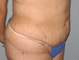 Patient # 27635 After Photo # 4
