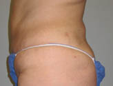 Patient # 27635 After Photo # 6