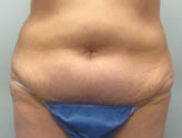 Patient # 27635 Before Photo # 1