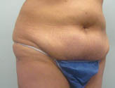 Patient # 27635 Before Photo # 3