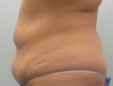 Patient # 27635 Before Photo # 5