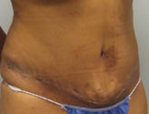 Patient # 28469 After Photo # 4