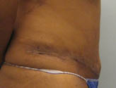 Patient # 28469 After Photo # 6