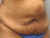 Patient # 28469 Before Photo # 3