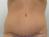 Patient # 70694 After Photo # 2
