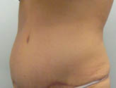 Patient # 70694 After Photo # 4