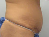 Patient # 70694 After Photo # 6