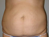 Patient # 70694 Before Photo # 1