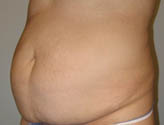 Patient # 70694 Before Photo # 3