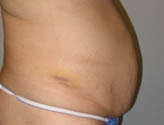Patient # 70694 Before Photo # 5