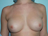 Patient # 11748 Before Photo # 1