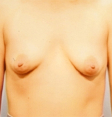 Patient # 30964 Before Photo # 1