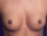 Patient # 54654 Before Photo # 1