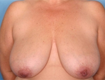 Patient # 82780 Before Photo # 1