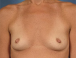 Patient # 69557 Before Photo # 1