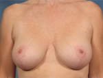 Patient # 47607 After Photo # 2