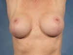 Patient # 47607 After Photo # 4