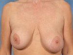 Patient # 47607 Before Photo # 1