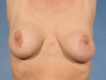 Patient # 47607 Before Photo # 3