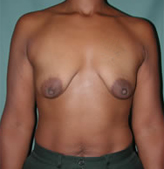 Patient # 41880 Before Photo # 1