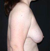 Patient # 25933 Before Photo # 5