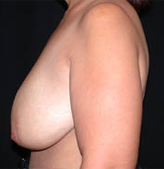 Patient # 93257 Before Photo # 5