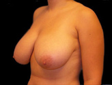 Patient # 12715 Before Photo # 3