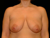 Patient # 27163 Before Photo # 1