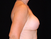 Patient # 34099 After Photo # 6