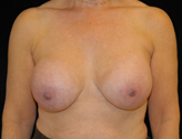 Patient # 34099 Before Photo # 1